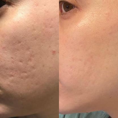 DermaPatch™ Hautglättende Wundpflaster